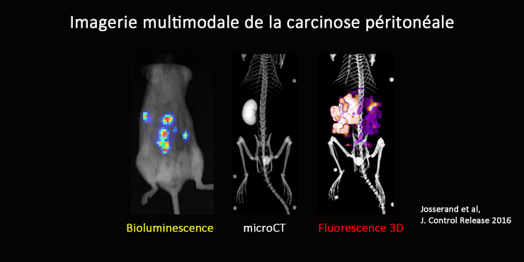 Illustration d'imagerie multimodale de la carcinose péritonéale