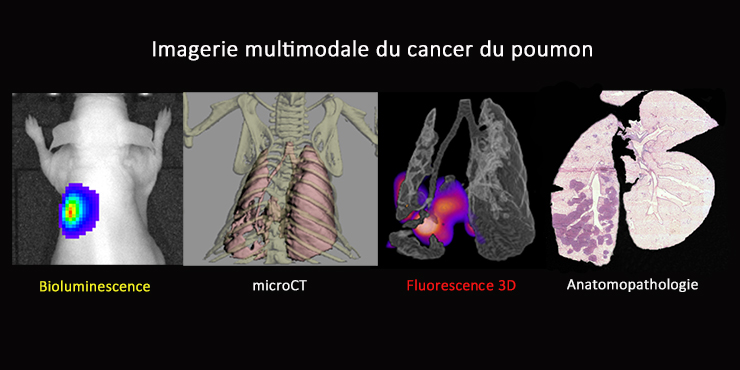 Illustration d'imagerie multimodale du cancer du poumon